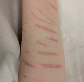 Self-harm Intentional injury to ones own body without the intention of suicide