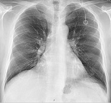 Follow-up chest X-ray after insertion of a port, with a malpositioned tip in the azygos vein. X-ray of port-a-cath in azygos vein - anteroposterior.jpg