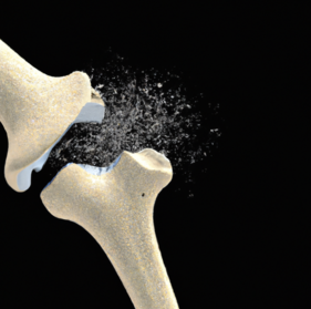 3-D rendering of a bone joint with a drug eluting coating. 3D rendering of bone joint with drug-eluting coating.png