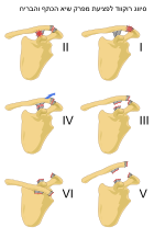 Thumbnail for File:ACJ injuries classification.svg