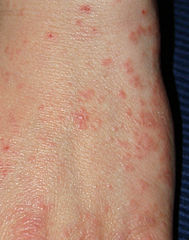 Scabies of the hand