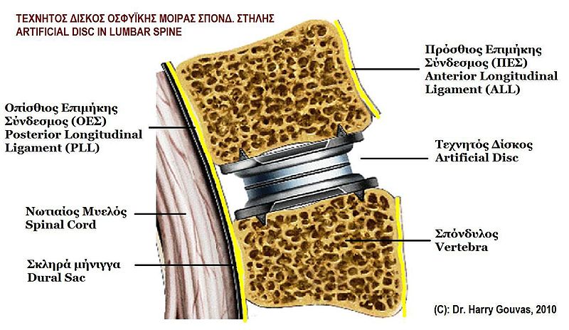 File:Artificial disc in lumbar spine.jpg