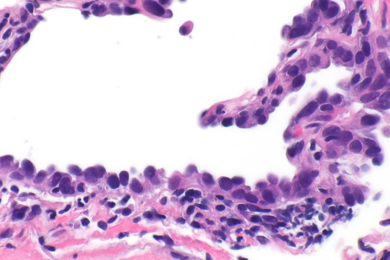 File:Atypical adenomatous hyperplasia -- very high mag.jpg