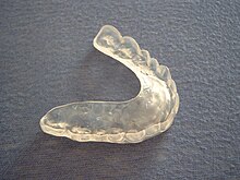 An upper, full coverage occlusal splint. Aufbissschiene.jpg