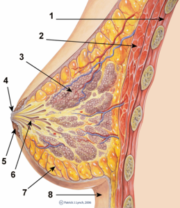 Papilloma intraduttale benigno, Papilloma intraduttale della mammella