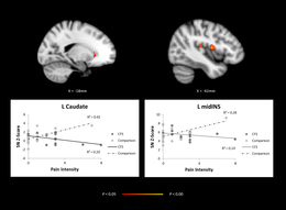Brain imaging, comparing adolescents with CFS and healthy controls showing abnormal network activity in regions of the brain.