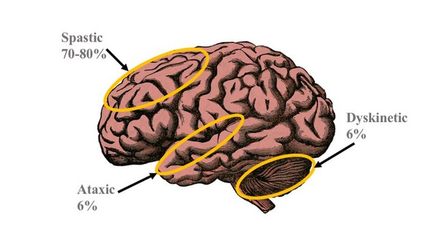 types of cerebral palsy brain