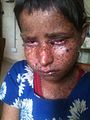 Child suffering from Xeroderma Pigmentosum in Rukum,Nepal.jpg