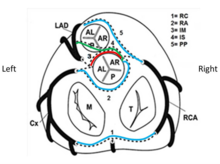 General scheme to identify possible courses of normal and ectopic coronary origin. AL = antero-left; AR = antero-right; Cx = circumfles artery; IM = intramural; IS = intraseptal; LAD = left anterior descending artery; M = mitral valve; P = posterior; PP = prepulmonic; RA = retroaortic; RC = retrocardiac; RCA = right coronary artery; T = tricuspid valve. Coronary artery anomalies.tif