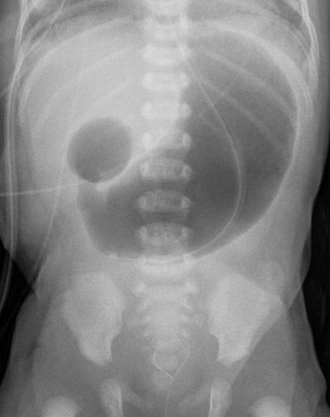 Frontal view of the abdomen with double bubble sign, patient was found to have duodenal atresia. DuodAtres.png