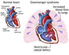 Heart with a ventricular septal defect showing Eisenmenger syndrome