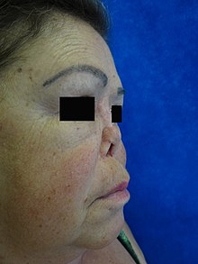 Lateral view of the face with a saddle nose deformity far up on the bridge due to granulomatosis with polyangiitis from using a nasal prosthesis Jmc2028e-g005.jpg