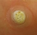 Thumbnail for Plantar wart