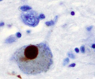 蓝染的细胞为脑神经细胞，其中最大的一颗细胞含有棕色的路易氏体构造，其直径占总细胞直径的40%。