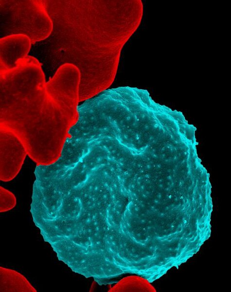 File:Malaria-infected Red Blood Cell.jpg