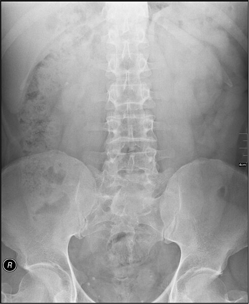 File:Medical X-Ray imaging CJK03 nevit.jpg