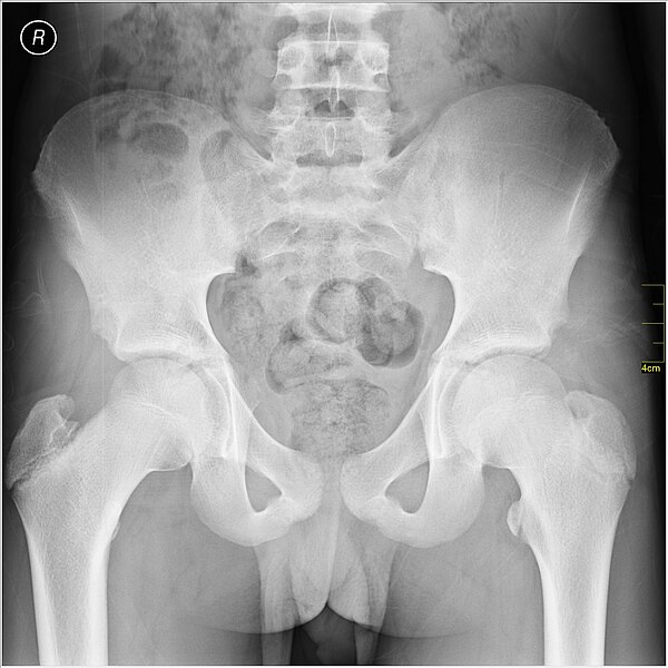 File:Medical X-Ray imaging PIM06 nevit.jpg