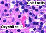Thumbnail for Oxyphil cell (parathyroid)