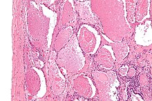 Intermediate magnification micrograph of pulmonary alveolar proteinosis. H&E stain. Pulmonary alveolar proteinosis -3- intermed mag.jpg