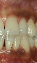 Smoker's melanosis in upper and lower gums.