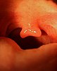 Gespleten huig (uvula bifida) bij een 24-jarige vrouw.