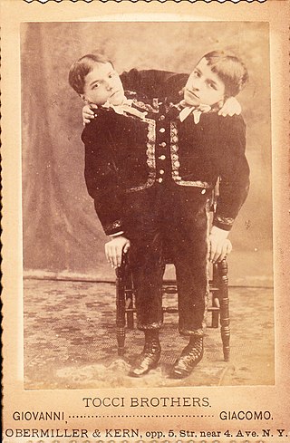 <span class="mw-page-title-main">Giacomo and Giovanni Battista Tocci</span> Italian conjoined twins