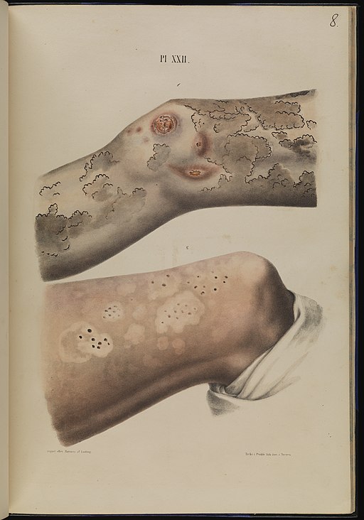  Tubercular leprosy on the leg Wellcome L0074847 