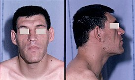 Rasgos faciales de acromegalia.JPEG