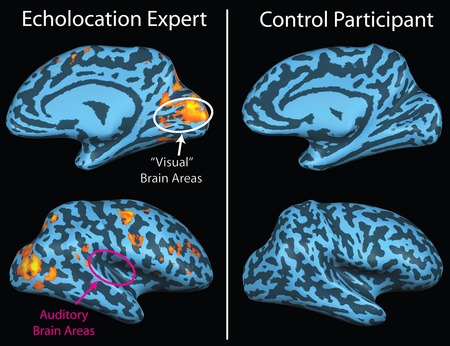 ไฟล์:Brain_image_of_blind_echolocator.tif