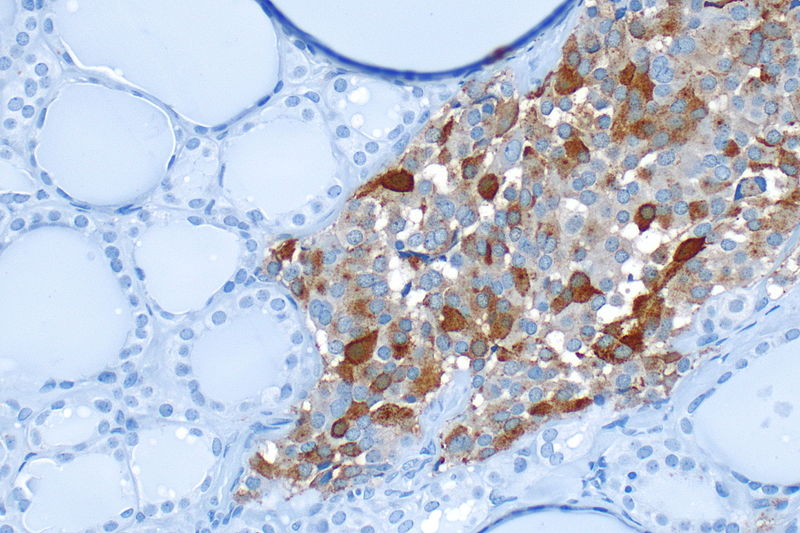 File:C-cell hyperplasia in MEN 2 - chromo A -- high mag.jpg