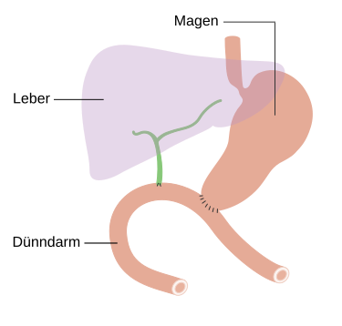 File:Diagramm nach totaler Pankreasresektion.svg