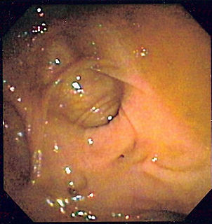 Diverticulosis Condition of having diverticula (outpocketings) in the wall of the intestine