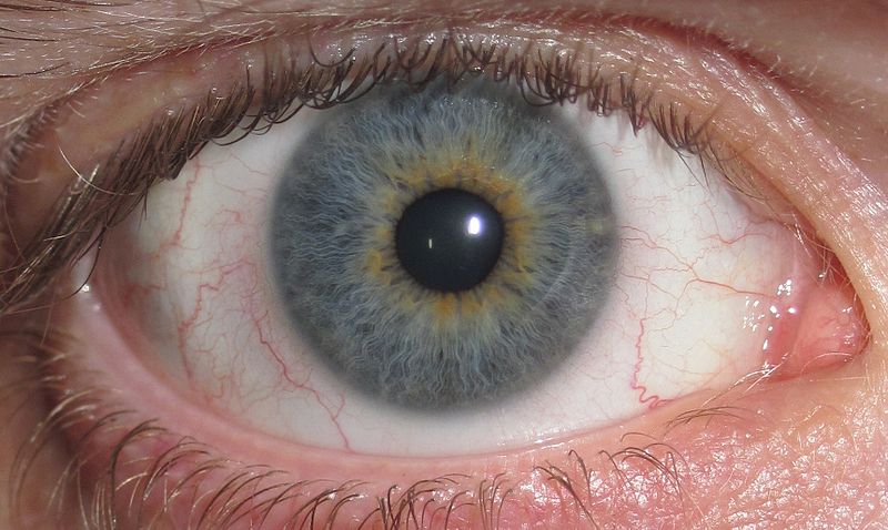 File:Eye Central Heterochromia crop.jpg