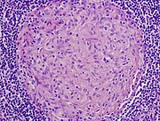 Granulom bez nekrózy v lymfatickém uzlíku způsobený infekcí Mycobacterium avium
