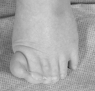 The foot of the patient with Greig cephalopolysyndactyly shows a partially duplicated hallux with cutaneous syndactyly of several digits.