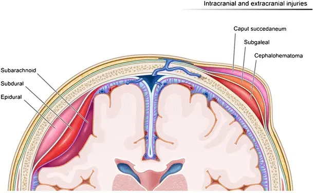 File:Illustration depicting hemorrhages by location within the different layers of the meninges (left of image) and scalp (right of image).webp