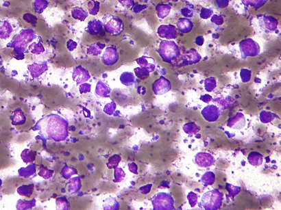 Large b cell lymphoma - cytology small.jpg