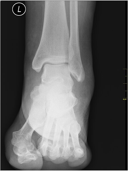 File:Medical X-Ray imaging WNK07 nevit.jpg