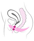 Miniatura per Esferes intravaginals