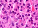 Vävnadsprov som vid mikroskopi visar den histopatologiska bilden av plasmocytom. HE-färgning.
