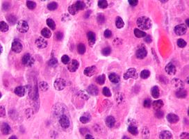 Micrograph of a plasmacytoma. H&E stain.