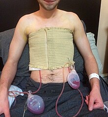 Trans man with two Jackson-Pratt drains after keyhole mastectomy Post-operative Jackson-Pratt Drains.JPG