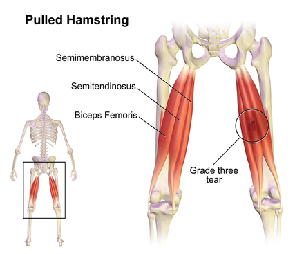 Picture of pulled hamstring showing location of hamstring.