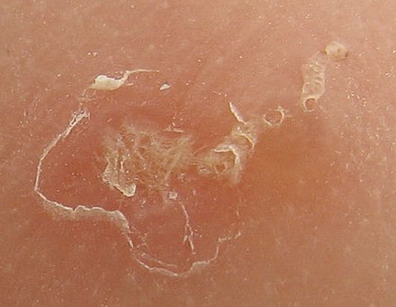 Magnified view of a burrowing trail of the scabies mite. The scaly patch on the left was caused by scratching and marks the mite's entry point into the skin. The mite has burrowed to the top-right, where it can be seen as a dark spot at the end.