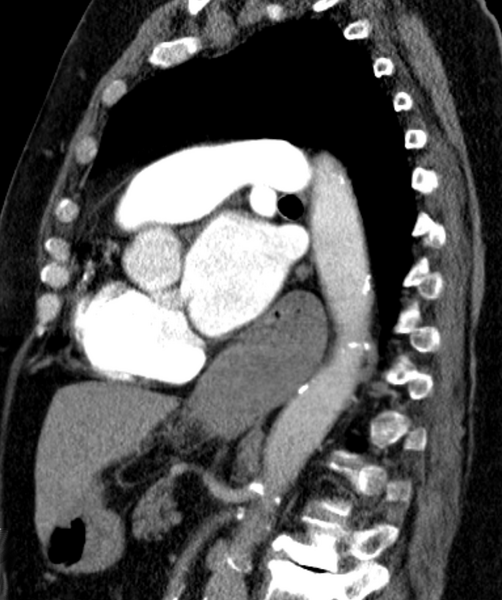 File:08-02-Hiatushernie CT sagittal.png