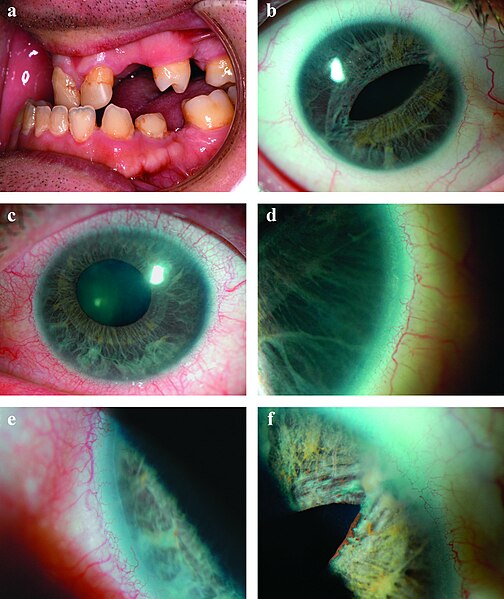 File:Axenfeld syndrome.jpg