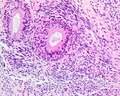 Thumbnail for Biphenotypic sinonasal sarcoma