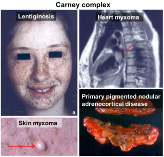 <span class="mw-page-title-main">Carney complex</span> Medical condition