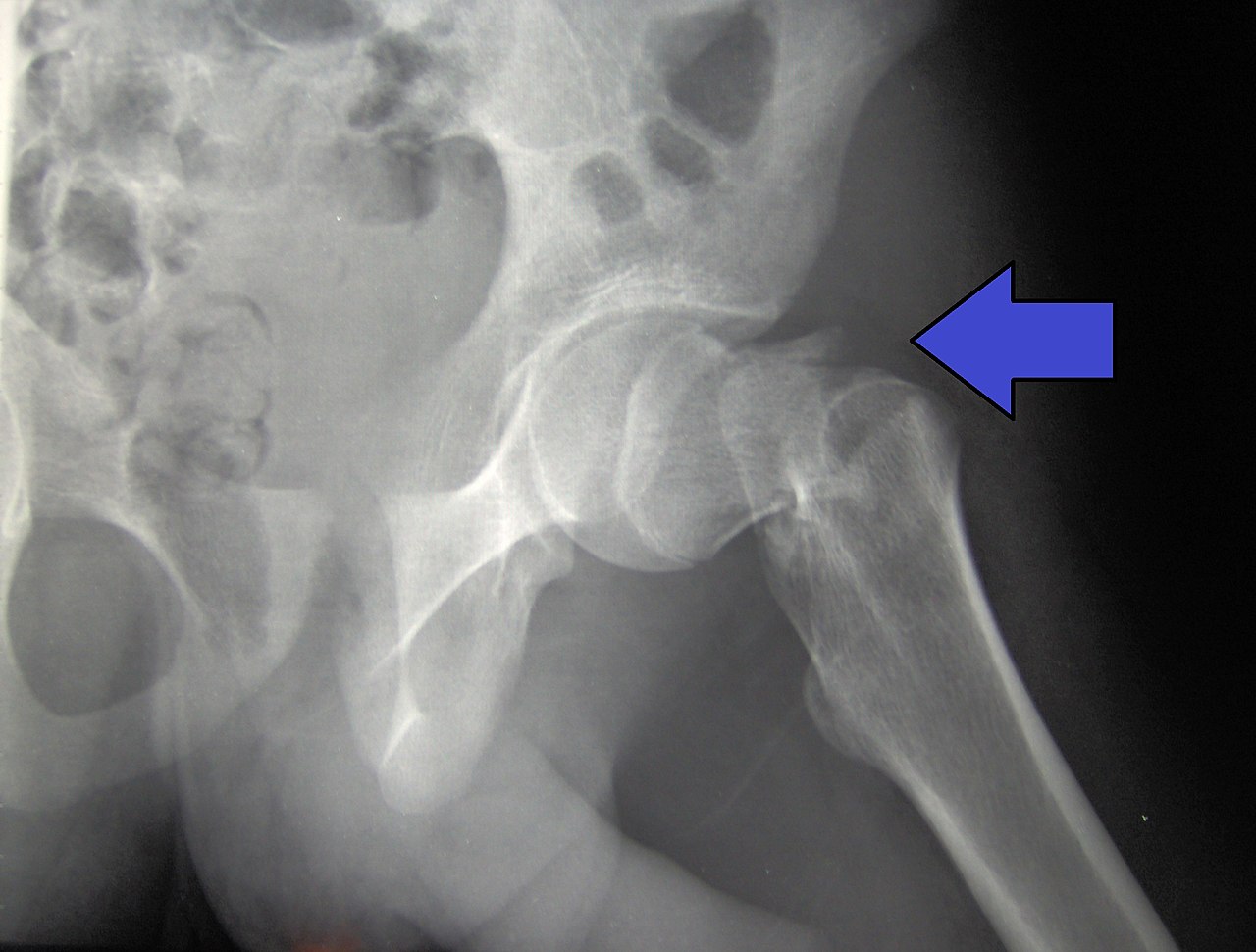 1280px-Cdm_hip_fracture_343