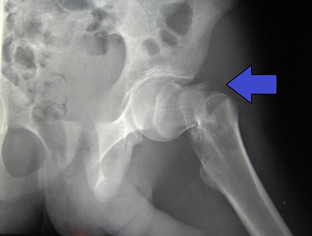 Hip Fractures-avatar